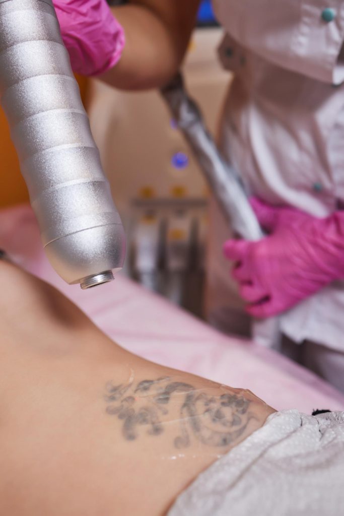 laser tattoo removal in Cumming, GA